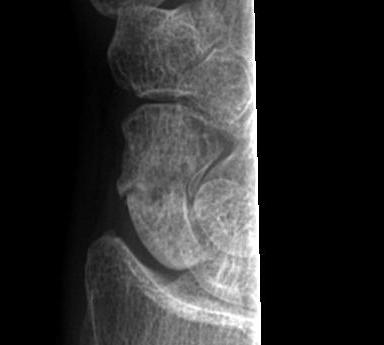 Scaphoid Nonunion Xray 2